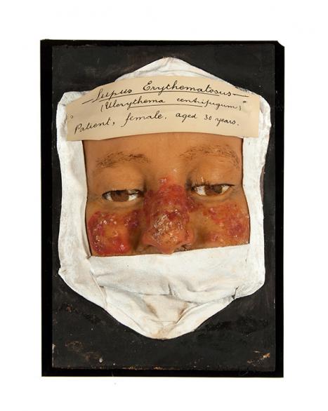 Herman Lawrence Australia (1863–1936) Moulage of the face, Lupus Erythematous (Ulerythema centrijugum) c1900 painted wax, gypsum Harry Brookes Allen Museum of Anatomy and Pathology 531-000279 