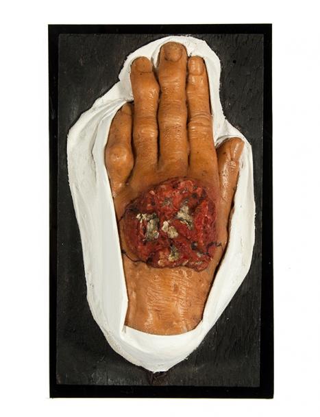 Herman Lawrence Australia (1863–1936) Moulage of the dorsum of the hand. Ulcerated radiation burn common in radiographers of the time c1900 painted wax, gypsum Harry Brookes Allen Museum of Anatomy and Pathology 531-002347 