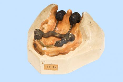 Major Kenneth Russell Australia (1885–1945) Cast splint with vulcanite extensions to stabilise the soft palate c1917 treated gypsum, brass, vulcanite Henry Forman Atkinson Dental Museum Reg. no. 2646 