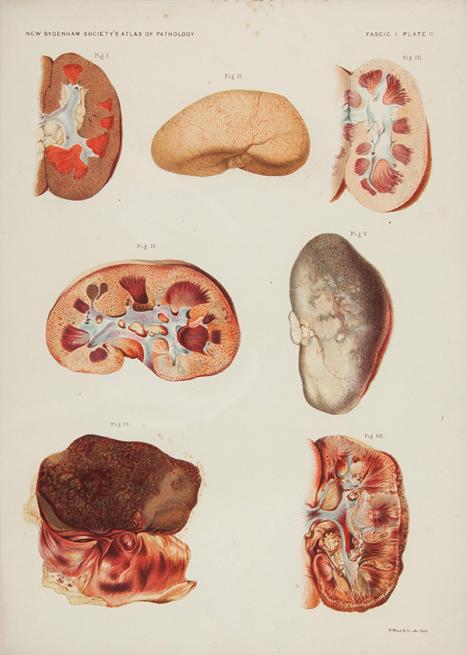 New Sydenham Society (1877–1898) An atlas of illustrations of pathology, Fascicule I-X11 issued by the New Sydenham Society, 1899 book Harry Brookes Allen Museum of Anatomy and Pathology 