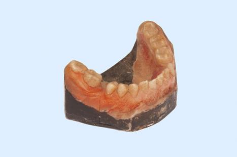 Maker unknown Model of lower dentate jaw with growth c1900 coloured wax on gypsum Henry Forman Atkinson Dental Museum Reg. no. 1975 