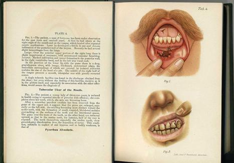 Ludwig Grünwald (1863–1927) Atlas and epitome of diseases of the mouth pharynx, and nose Philadelphia W.B. Saunders 1903 book Henry Forman Atkinson Dental Museum 